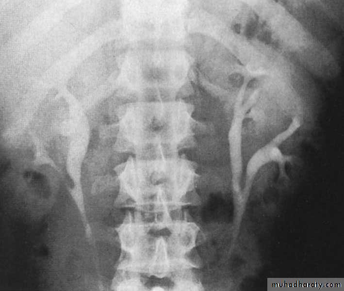 Congenital anomalies of the upper urinary tract