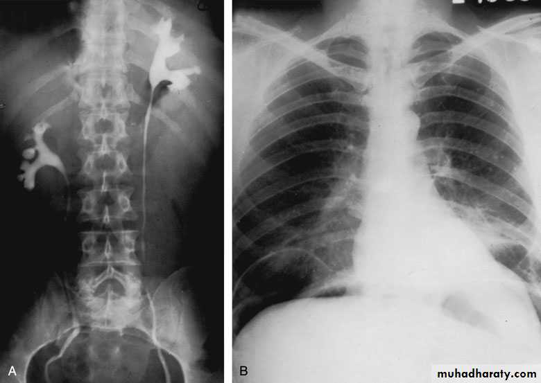 Congenital anomalies of the upper urinary tract