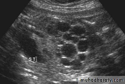 Congenital anomalies of the upper urinary tract