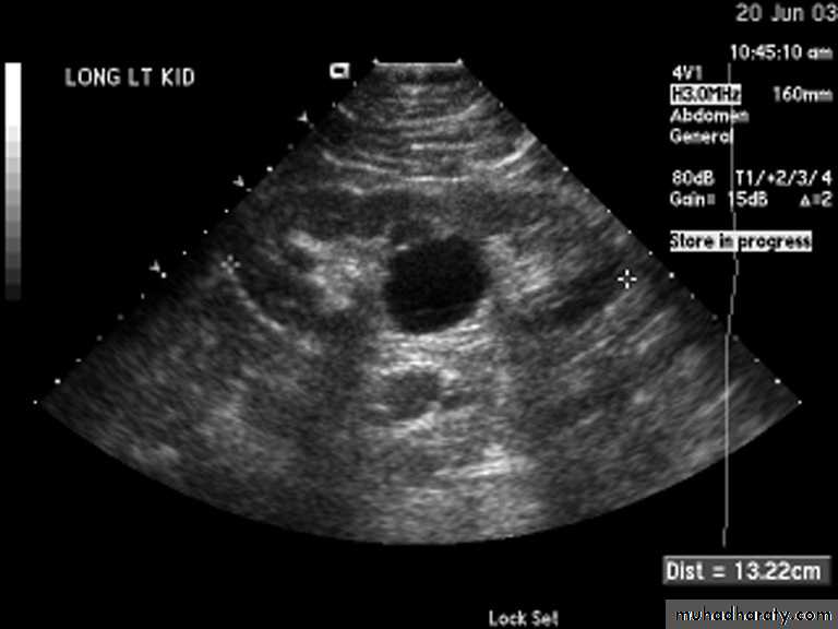 Congenital anomalies of the upper urinary tract