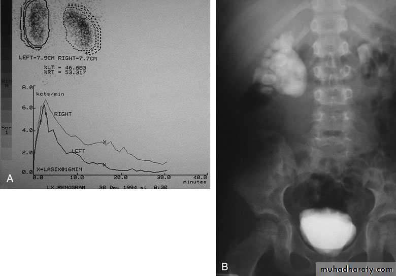 Congenital anomalies of the upper urinary tract