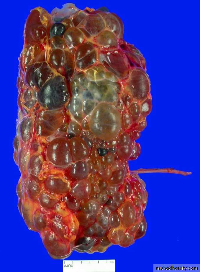 Congenital anomalies of the upper urinary tract