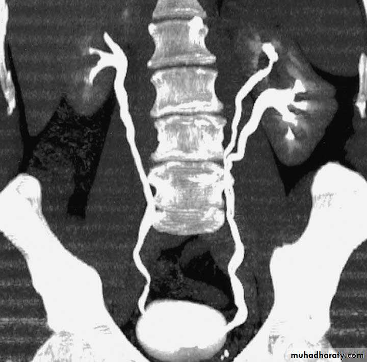 Congenital anomalies of the upper urinary tract