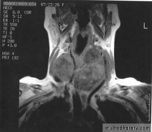 Thyroid gland