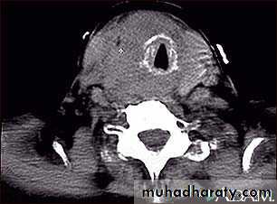 Thyroid gland