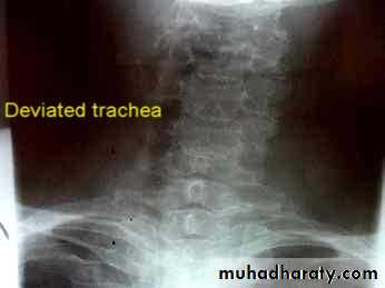 Thyroid gland