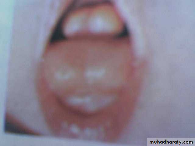 Thyroid gland