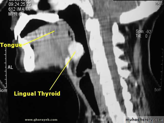 Thyroid gland