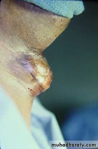 Thyroid gland