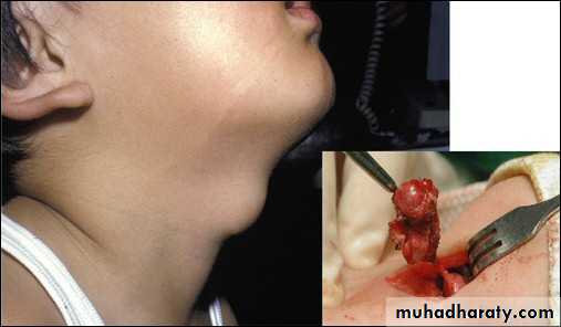 Thyroid gland