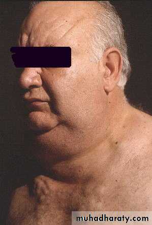 Thyroid gland