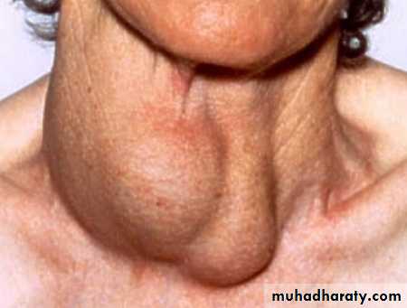 Thyroid gland
