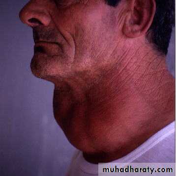Thyroid gland