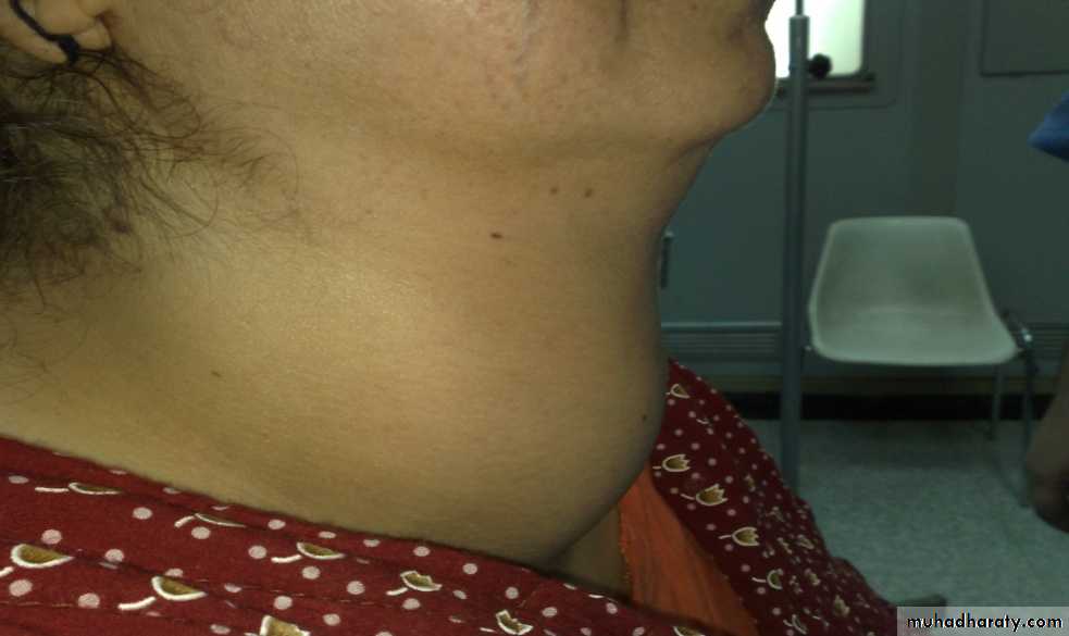 Thyroid gland