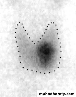 Thyroid gland