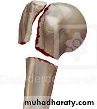 Injuries of upper limbs