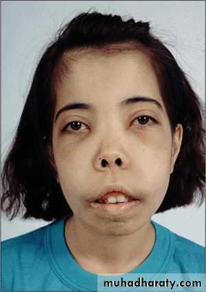 Thalassemia