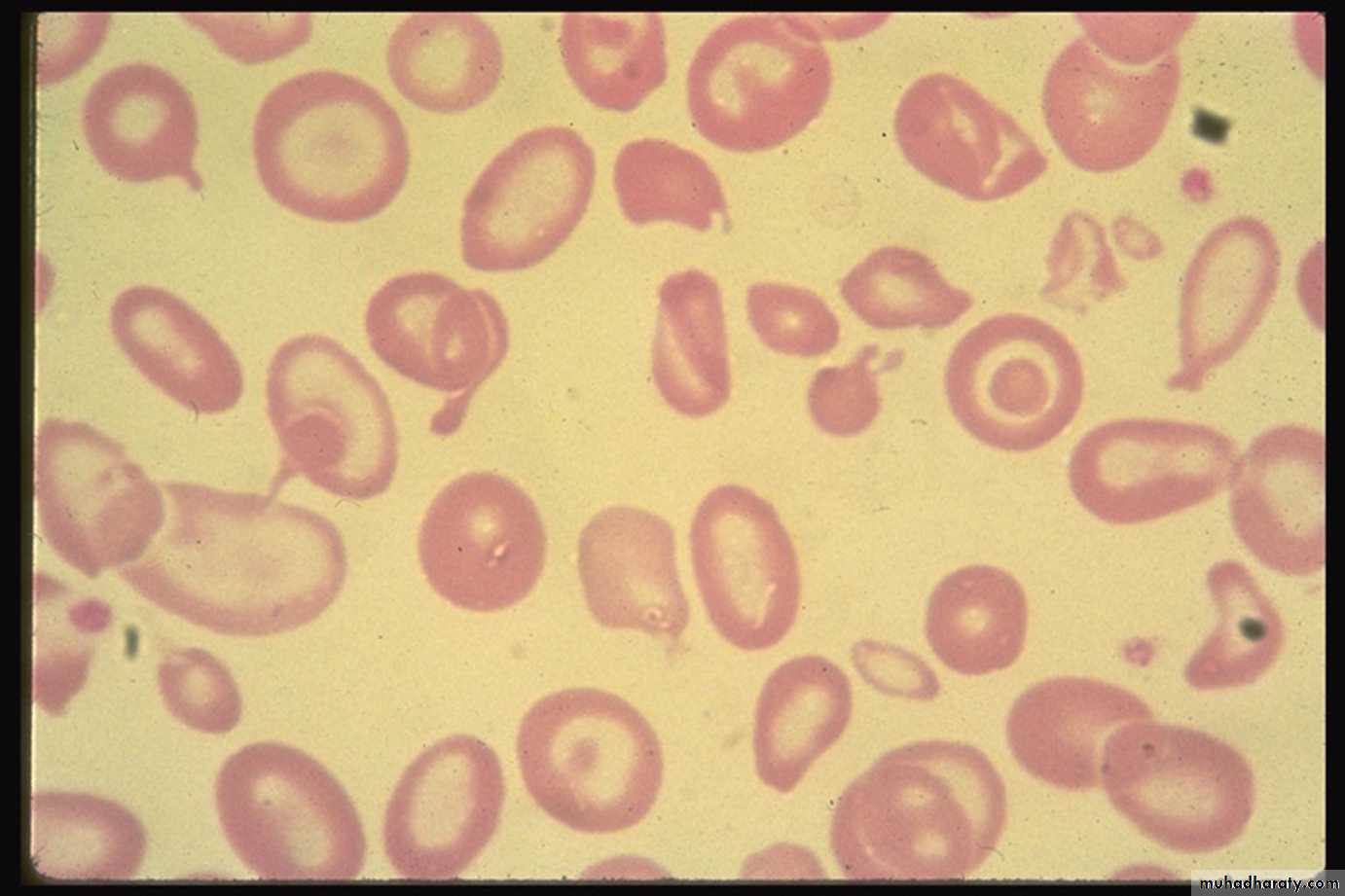 Thalassemia