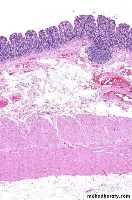 Pathology of GIT- Intestine