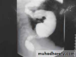 Pathology of GIT- Intestine