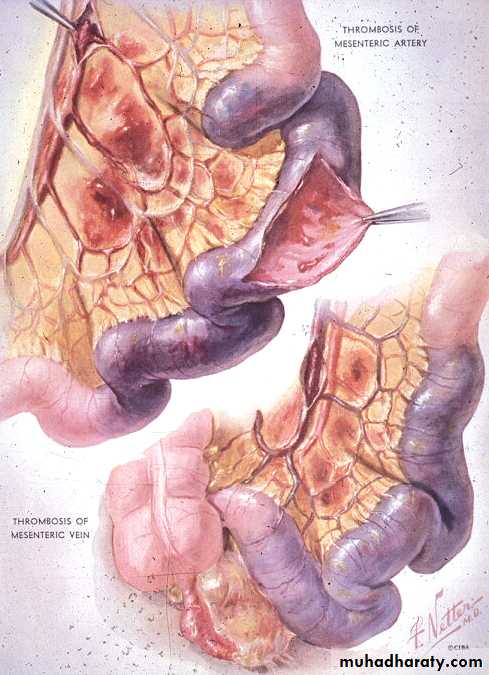 Pathology of GIT- Intestine