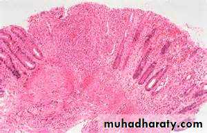 Pathology of GIT- Intestine