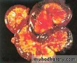 Pathology of GIT- Intestine