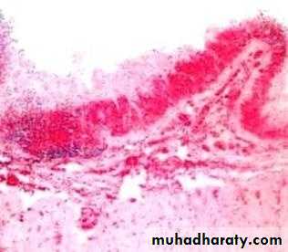 Pathology of GIT- Intestine