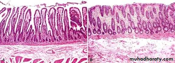 Pathology of GIT- Intestine