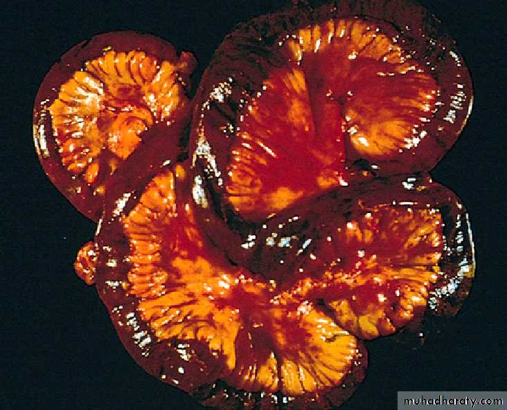 Pathology of GIT- Intestine