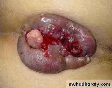 Pathology of GIT- Intestine
