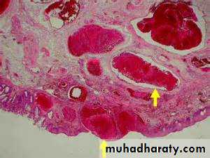 Pathology of GIT- Intestine