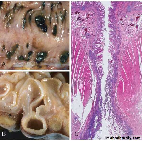 Pathology of GIT- Intestine