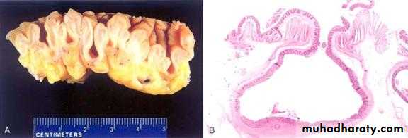 Pathology of GIT- Intestine