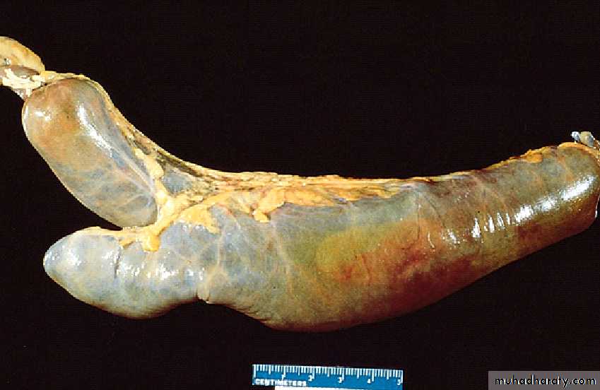 Pathology of GIT- Intestine