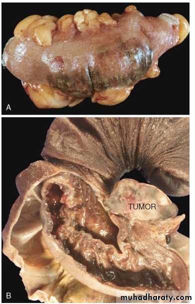 Pathology of GIT- Intestine