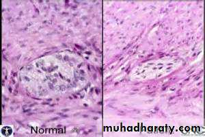 Pathology of GIT- Intestine