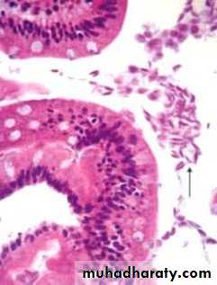 Pathology of GIT- Intestine