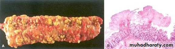 Pathology of GIT- Intestine