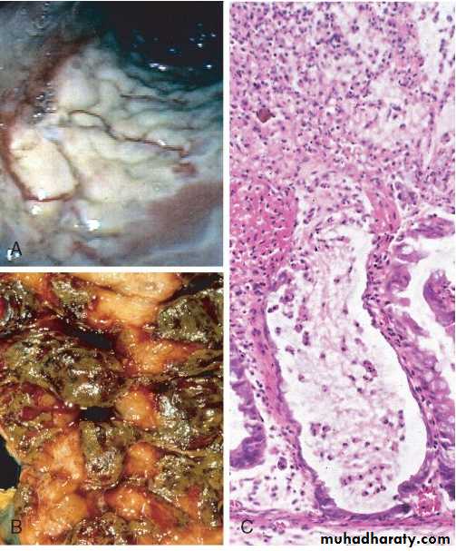 Pathology of GIT- Intestine