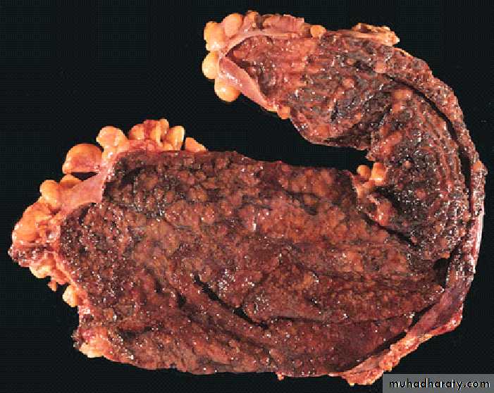 Pathology of GIT- Intestine