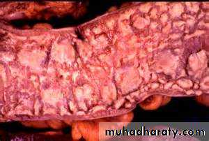 Pathology of GIT- Intestine