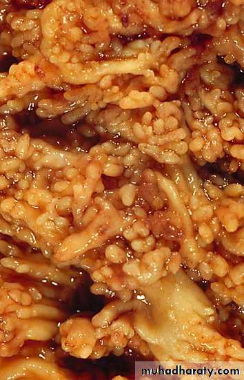 Pathology of GIT- Intestine