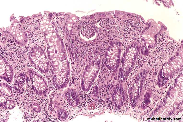 Pathology of GIT- Intestine