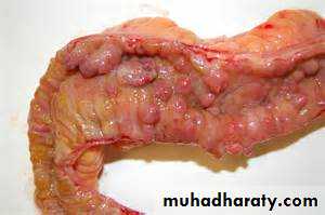 Pathology of GIT- Intestine