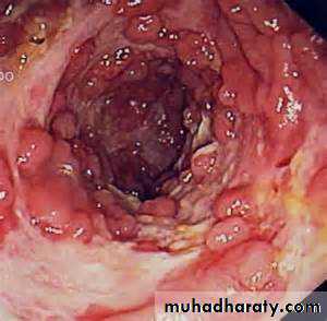 Pathology of GIT- Intestine