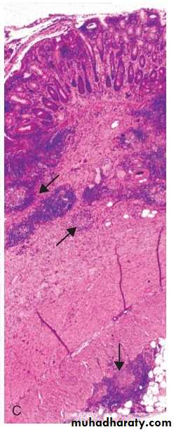 Pathology of GIT- Intestine