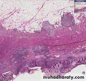 Pathology of GIT- Intestine