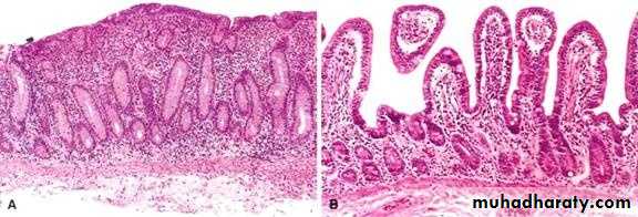 Pathology of GIT- Intestine