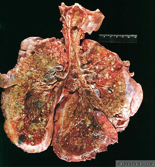 Pathology of GIT- Intestine